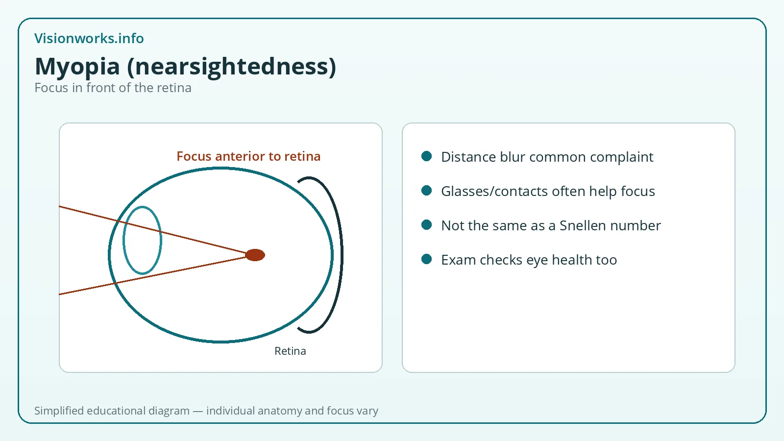Simplified educational focusing diagram for Myopia (nearsightedness)